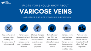 Facts You Should Know About Varicose Veins