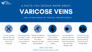 Symptoms of Varicose Veins and Vein Disease