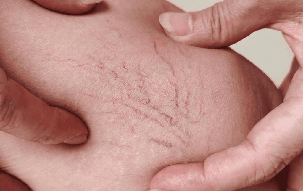 Top Eight Varicose Vein Risk Factors