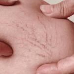 Top Eight Varicose Vein Risk Factors 7 Top Eight Varicose Vein Risk Factors