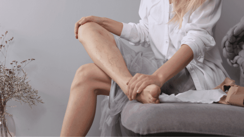 Top Eight Varicose Vein Risk Factors