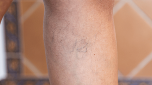 When Poor Circulation Could Be a Vein Issue