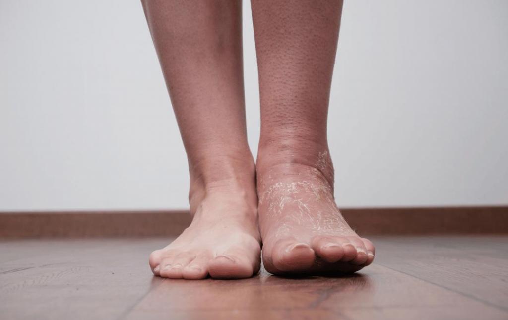 Why Is Only My Left Leg Swelling?