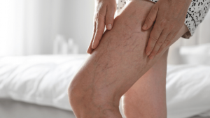 What Increases Your Risk of Blood Clots?