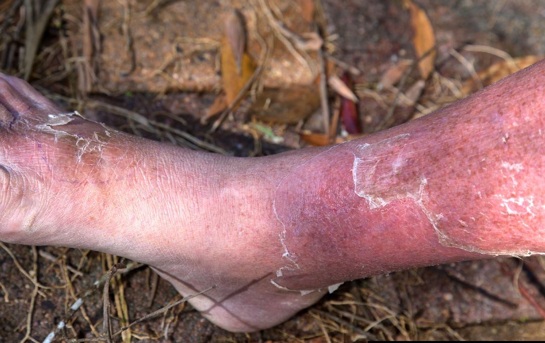 Leg that had varicose veins now with cellulitis