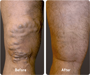 Additional benefits of endovenous laser vein treatment