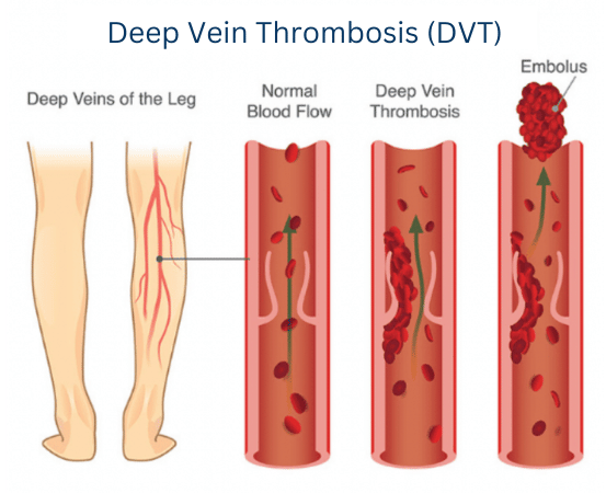Deep Vein Thrombosis (Dvt) 4 Complications of DVT
