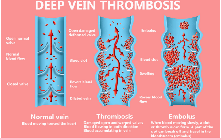Deep Vein Thrombosis (Dvt) 5 Deep Vein Thrombosis Symptoms