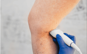 Diagnosis of Spider Veins