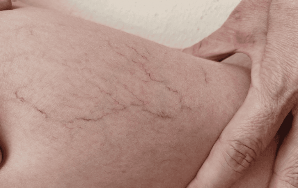 Spider Veins in Ankles and Feet