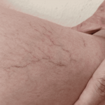 Spider Veins In Ankles And Feet: Causes And Treatment 12 Spider Veins in Ankles and Feet
