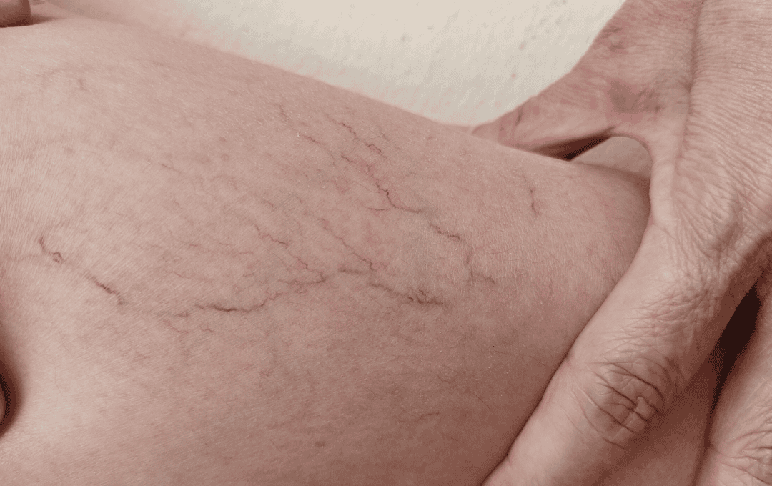 Spider Veins in Ankles and Feet