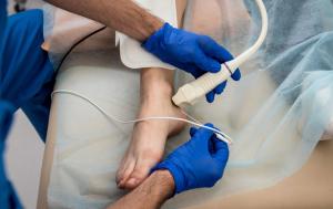 Vein Ablation
