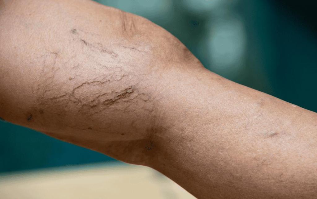 Why Are My Veins Blue