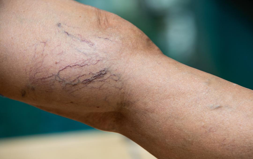 Spider Vein Spider Vein Does Whatever a Spider Vein Does