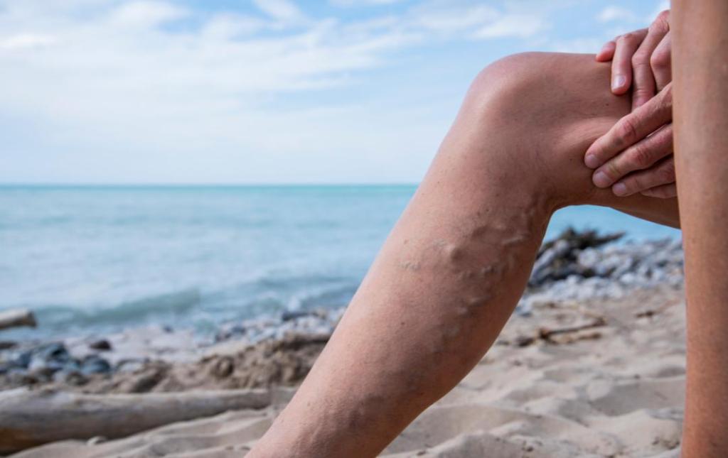 Varicose Veins at the Beach
