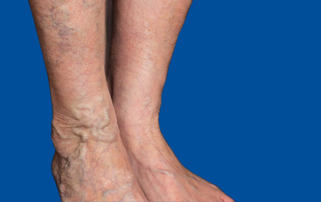 Varicose Veins in the Ankles