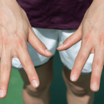 Visible Hand Veins Causes and Treatment Options