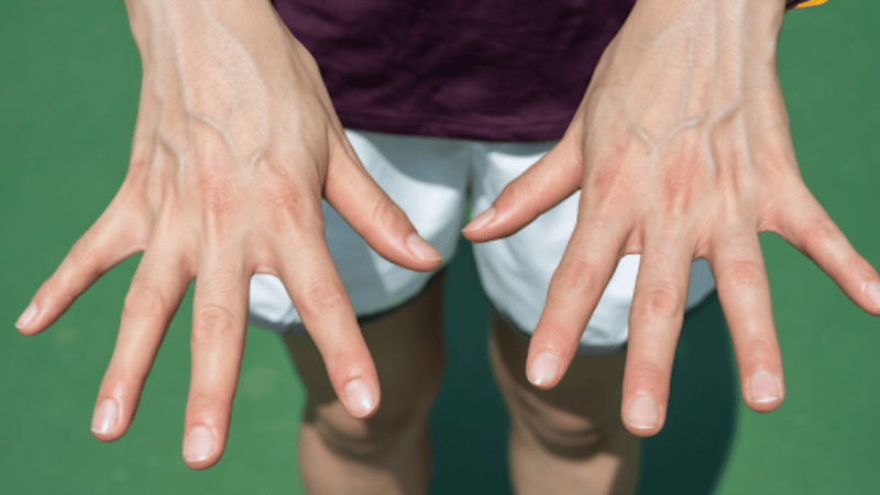 Visible Hand Veins Causes and Treatment Options