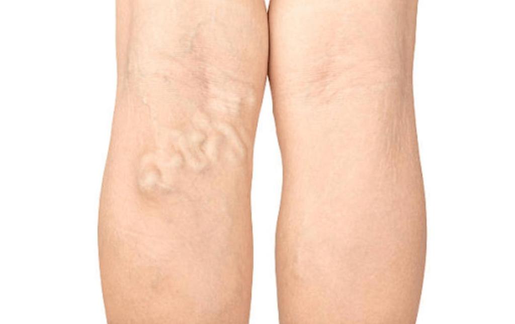 8 Early Signs of Deep Vein Thrombosis (DVT)