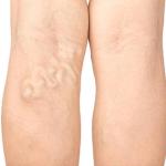 8 Early Signs of Deep Vein Thrombosis (DVT)