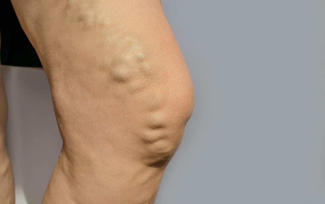 how diabetes affects veins