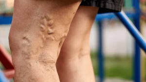 Deep Vein Thrombosis Early Symptoms