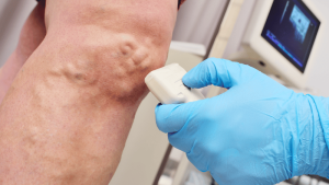 Types of Vein Treatments and Procedures