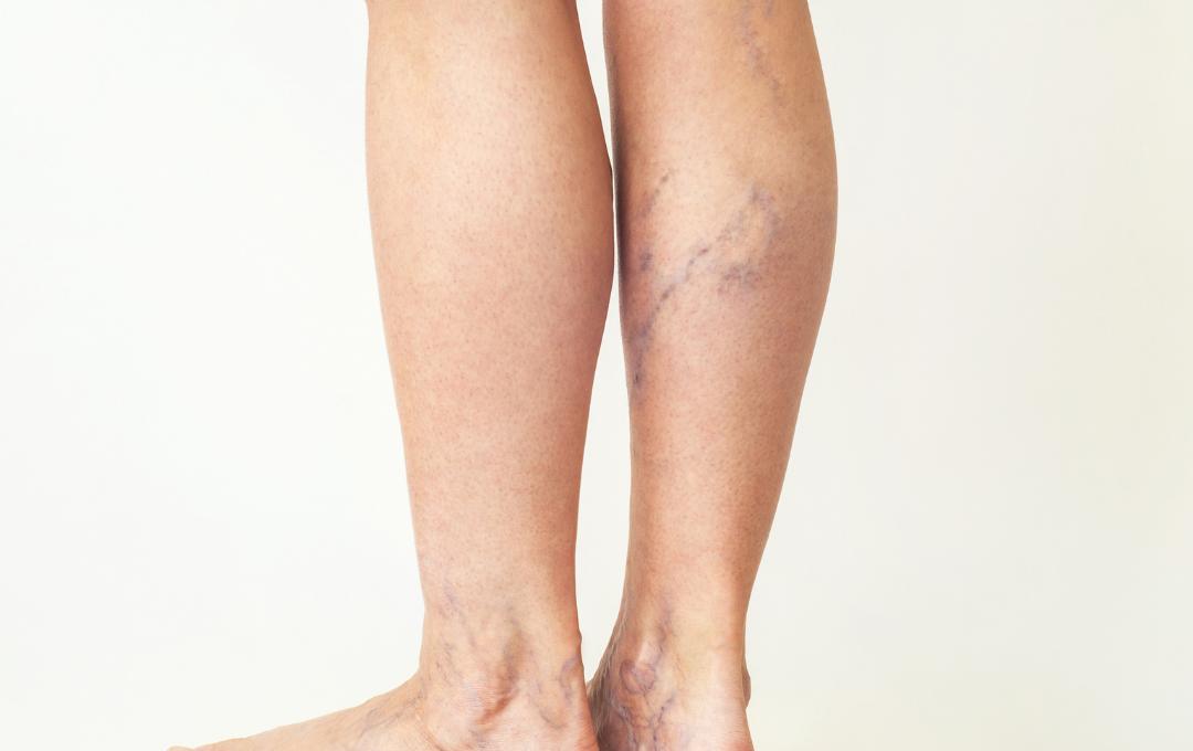 What Causes Veins to Look Blue vs. Green