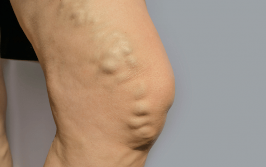 Can You Treat Varicose Veins Without Surgery?