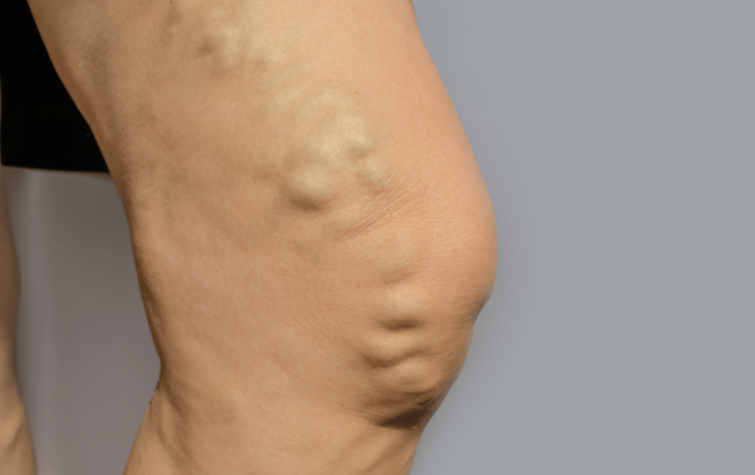 Can You Treat Varicose Veins Without Surgery?