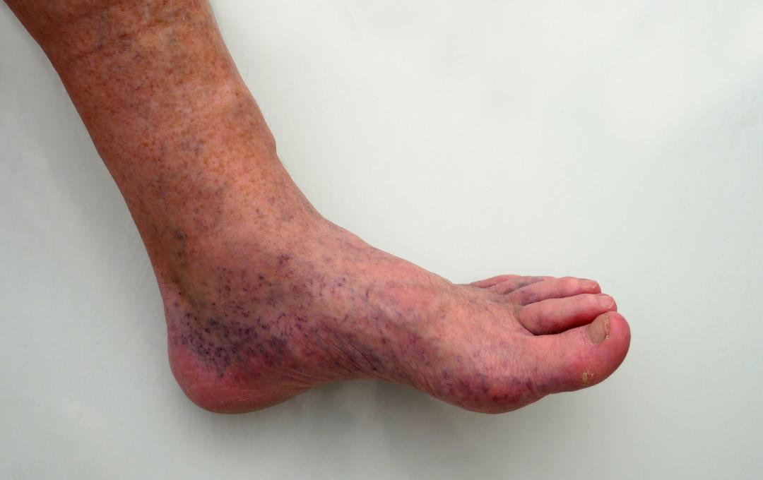 Understanding Skin Discoloration On The Legs Causes Treatments Understanding Skin Discoloration On The Legs Causes Treatments