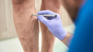Overview of Non-Surgical Vein Treatment Options
