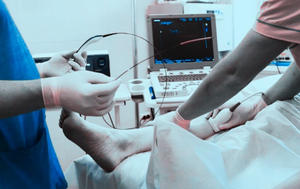 Best Effective Vein Treatments