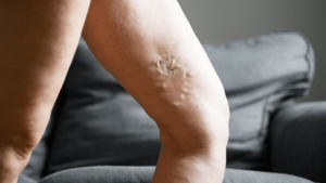 Early Stages of Chronic Venous Insufficiency