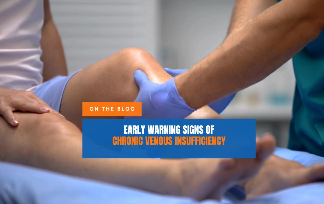 Early Warning signs of Chronic Venous Insufficiency 1