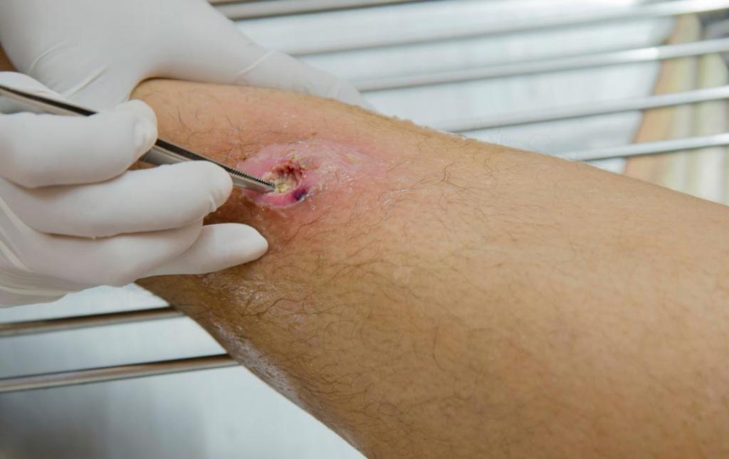 what do leg ulcers look like
