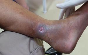 What Does An Unhealthy Vein Look Like? 12 Severe ulcer on ankle area