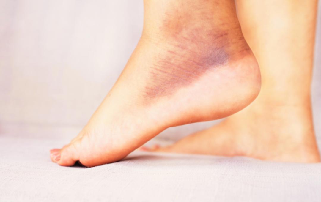 Understanding Hemosiderin Staining Causes & Symptoms
