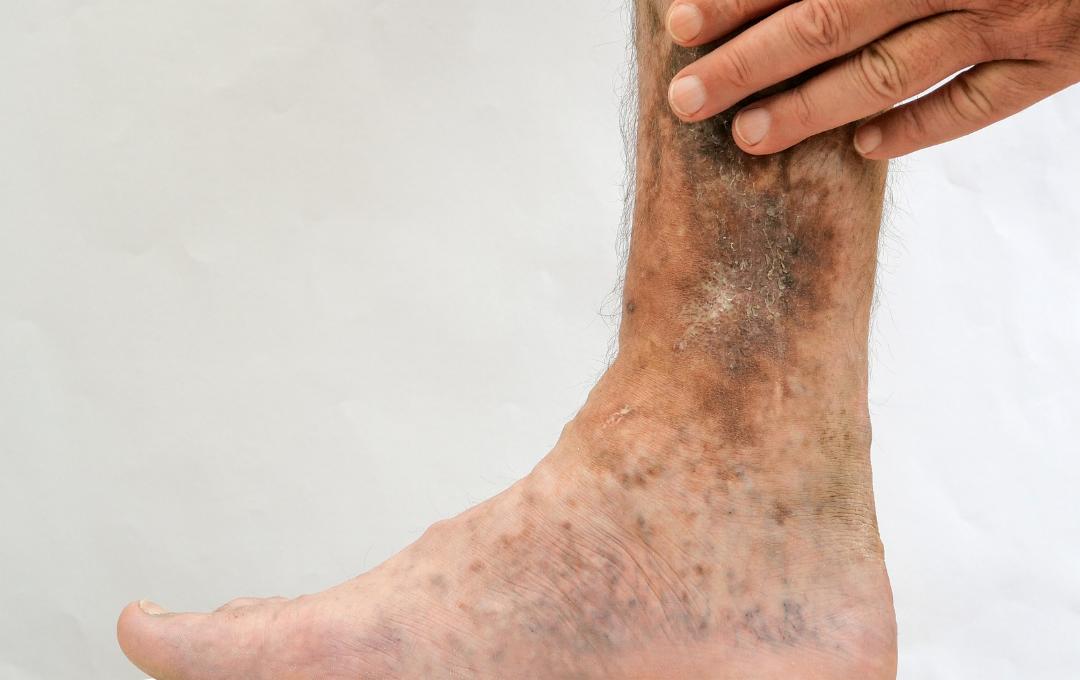 Venous ulcer stage 1