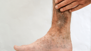  What Do Early Venous Leg Ulcers Look Like?