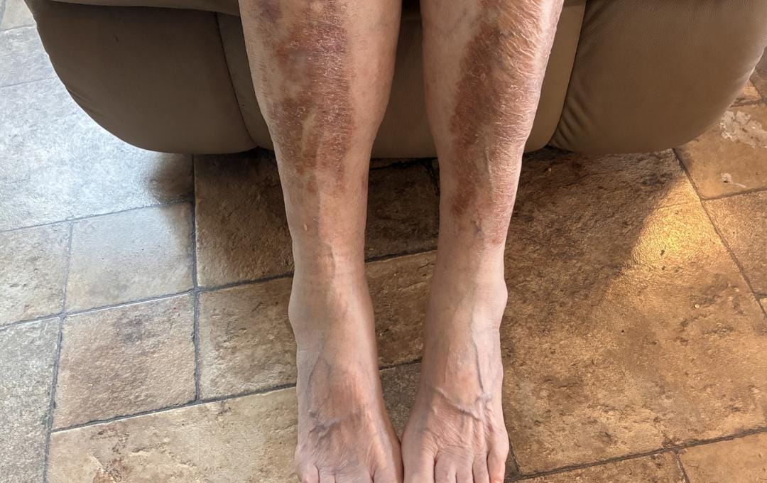 Hemosiderin Staining: Symptoms &Amp; Causes 5 Hemosiderin staining on a patient's shins looks like a brown, rust-colored discoloration.