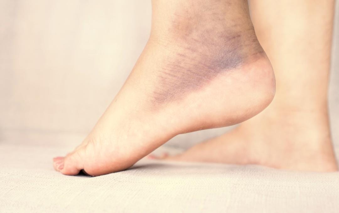 Hemosiderin Staining: Symptoms &Amp; Causes 4 Hemosiderin staining on the ankle.