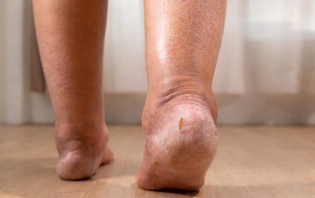 Hemosiderin Staining: Symptoms &Amp; Causes 6 Woman with symptoms of hemosiderin staining, including skin discoloration, swelling, and dryness.