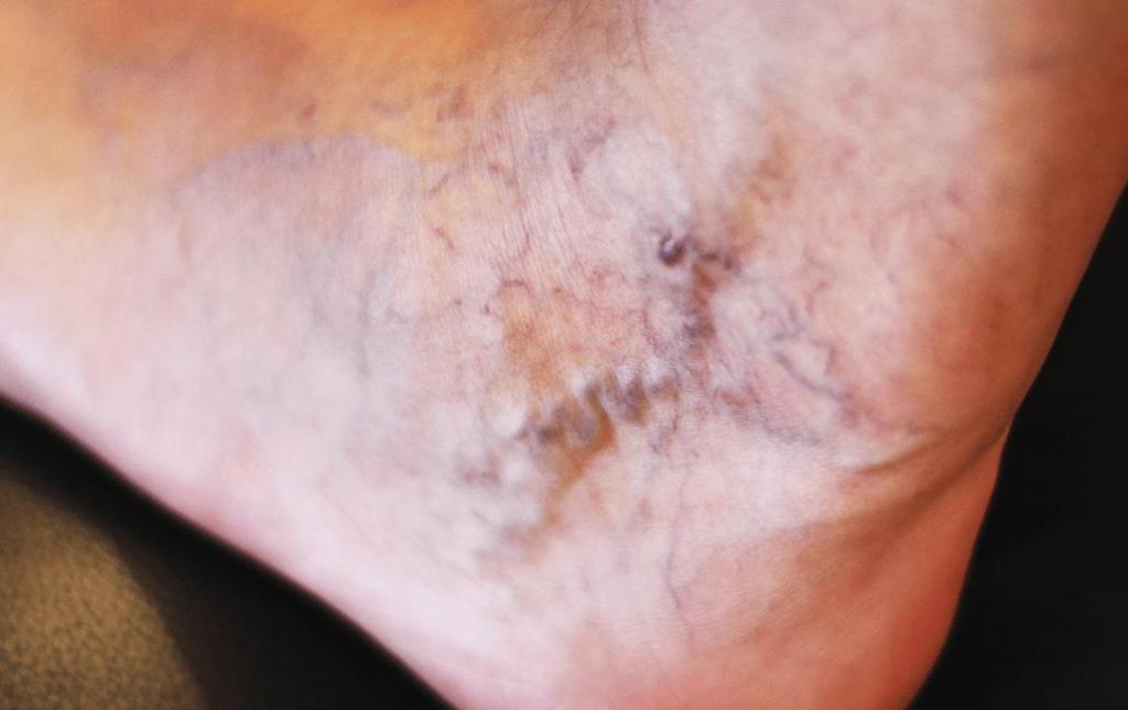 How and Why Do Veins Collapse