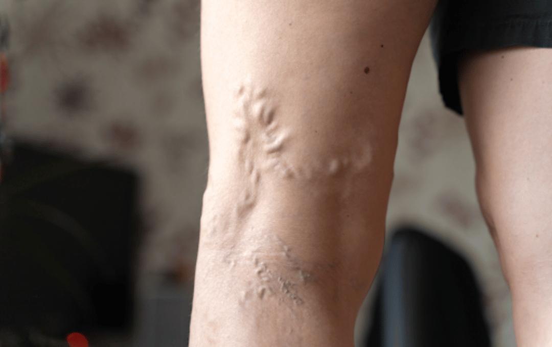 How to Improve Circulation in Legs While Sleeping