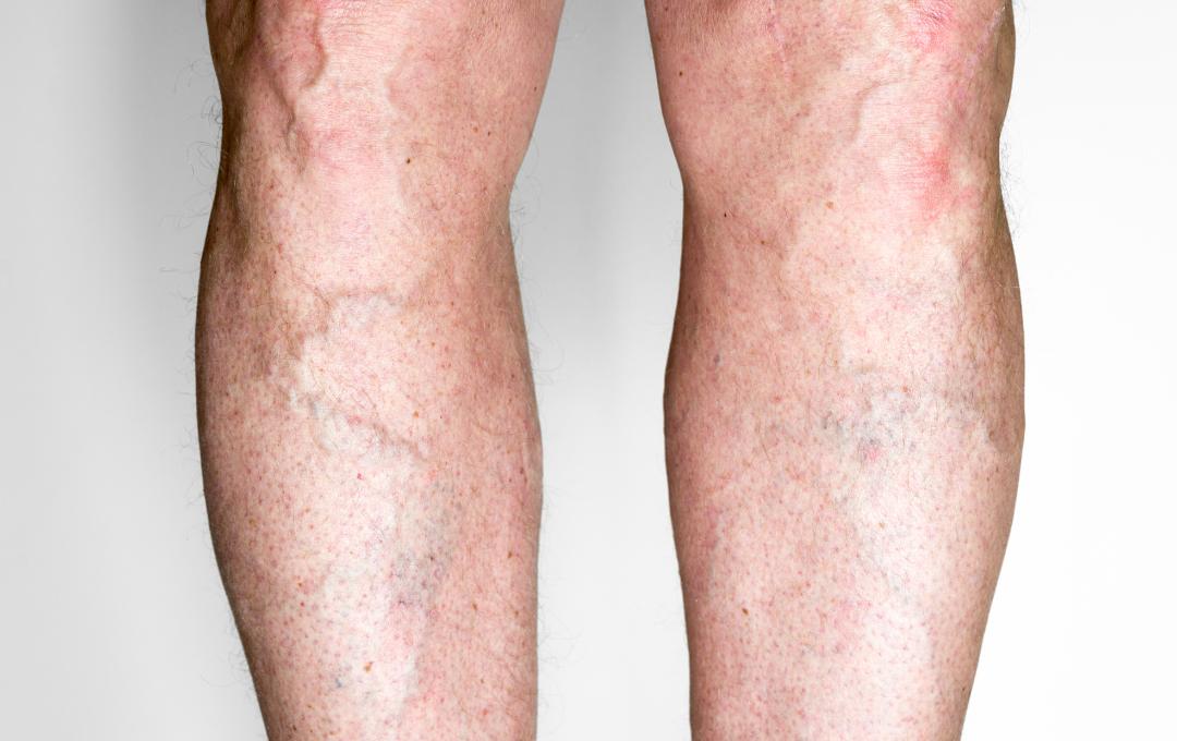 The Risks of a Sedentary Lifestyle on Veins