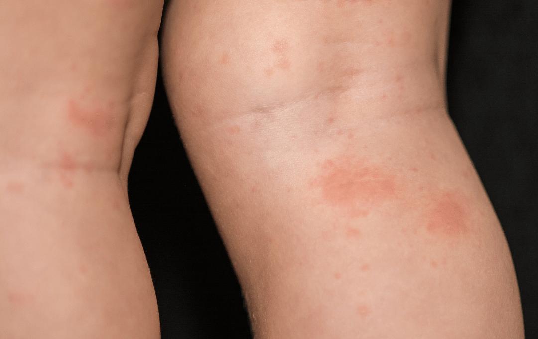 How Does Varicose Eczema Develop Causes, Symptoms & Treatment