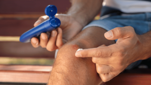 How to Manage Venous Stasis Dermatitis
