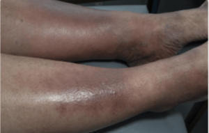 Severe Varicose Eczema Symptoms